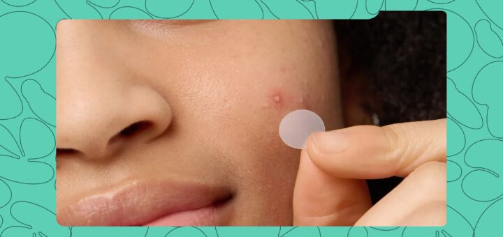 These 5 Pimple Patches are Nigerian Favourites for Their Price and Effectiveness