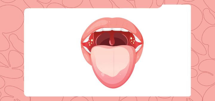 The Gross Truth About Tonsil Stones (and Why They Make Your Breath Smell)