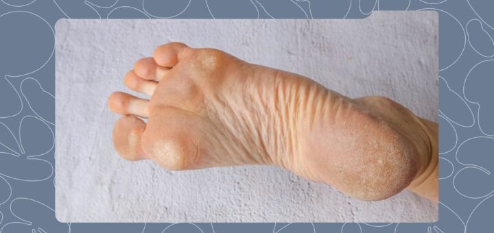 Safe and Effective Ways to Remove Callus From Your Feet