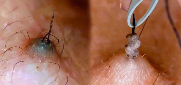 How to Get Rid of Ingrown Hair: Simple, Safe, and Effective Tips That Work